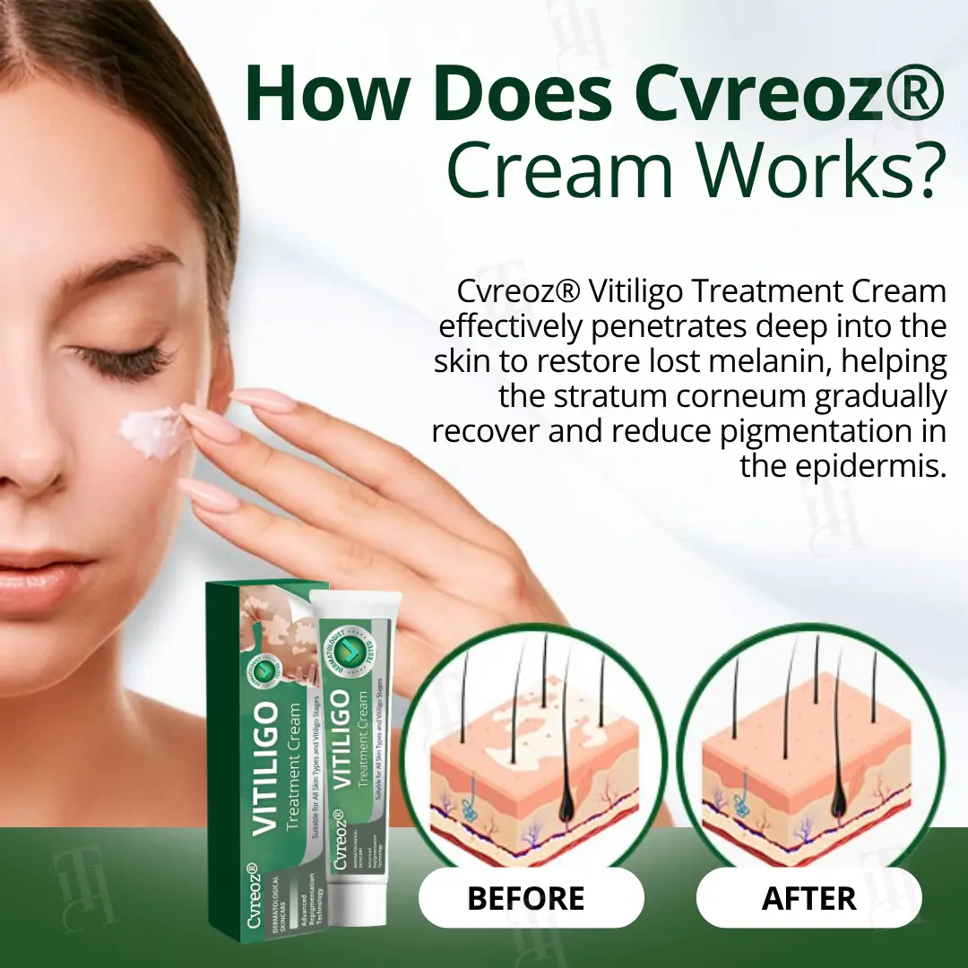 Vitiligo Treatment Cream - Image 2