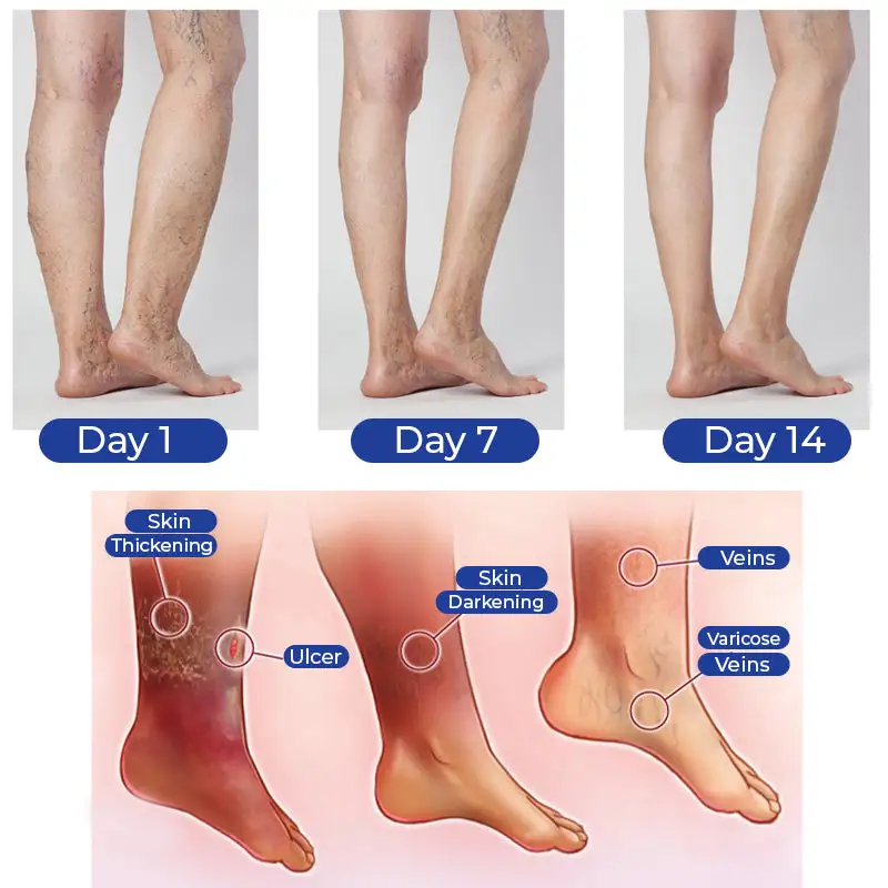 Vein Comfort Spray - Image 8