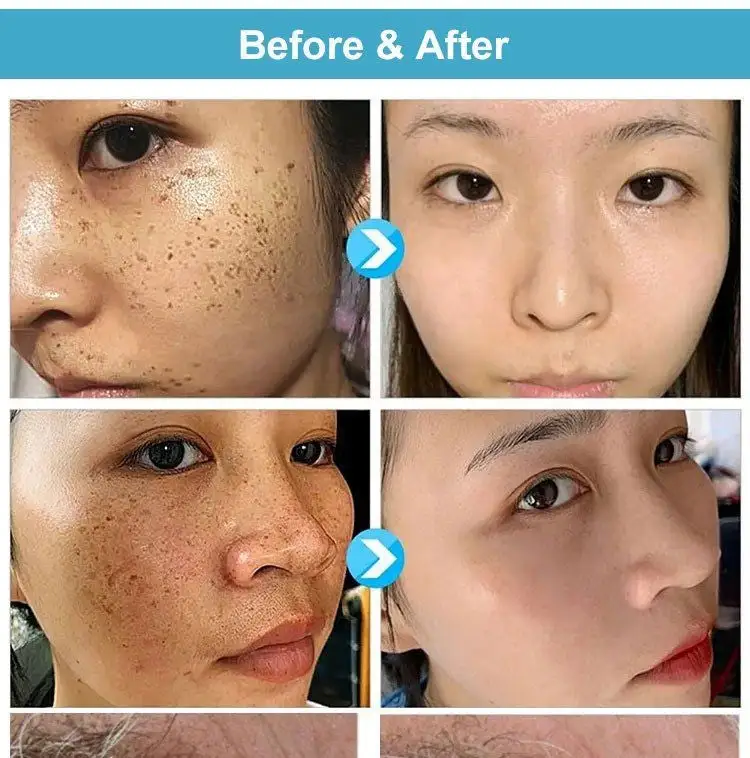 Concentrated potent skin tag removal cream - Image 3