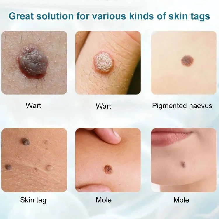 Concentrated potent skin tag removal cream - Image 6