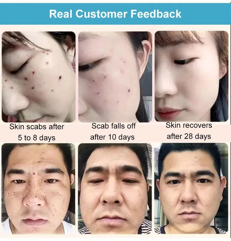 Concentrated potent skin tag removal cream - Image 4