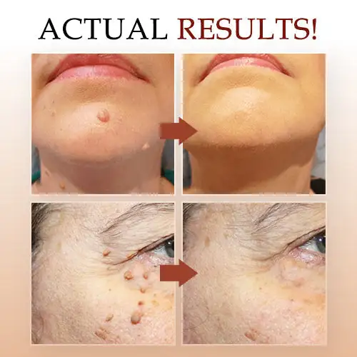 Concentrated potent skin tag removal cream - Image 5