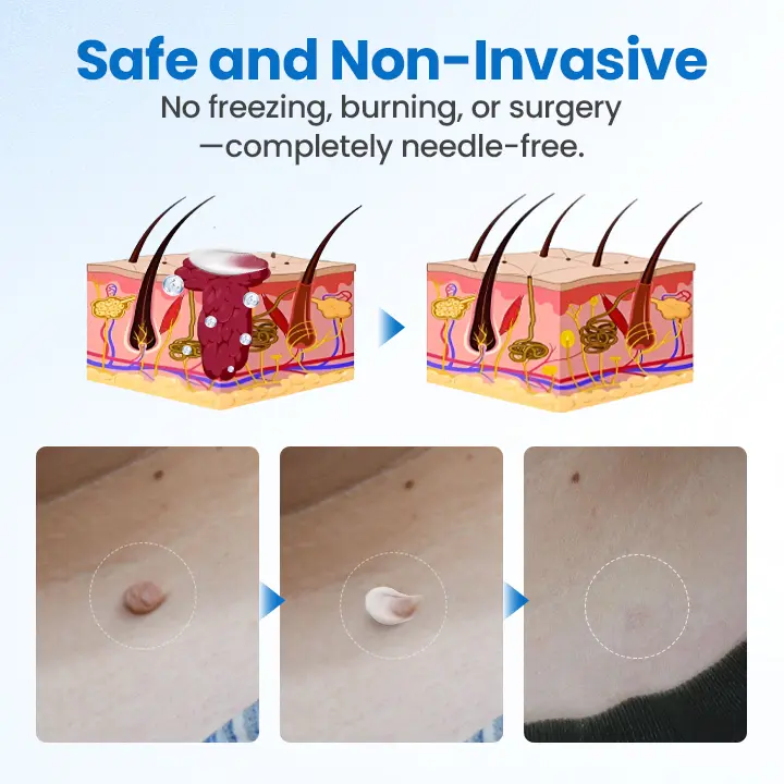 Wart Removal Cream - Image 6