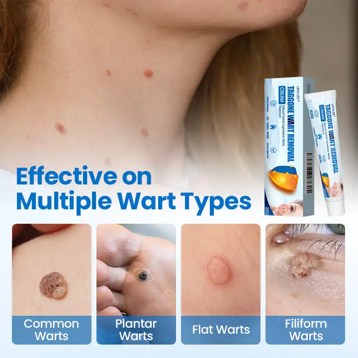 Wart Removal Cream - Image 4