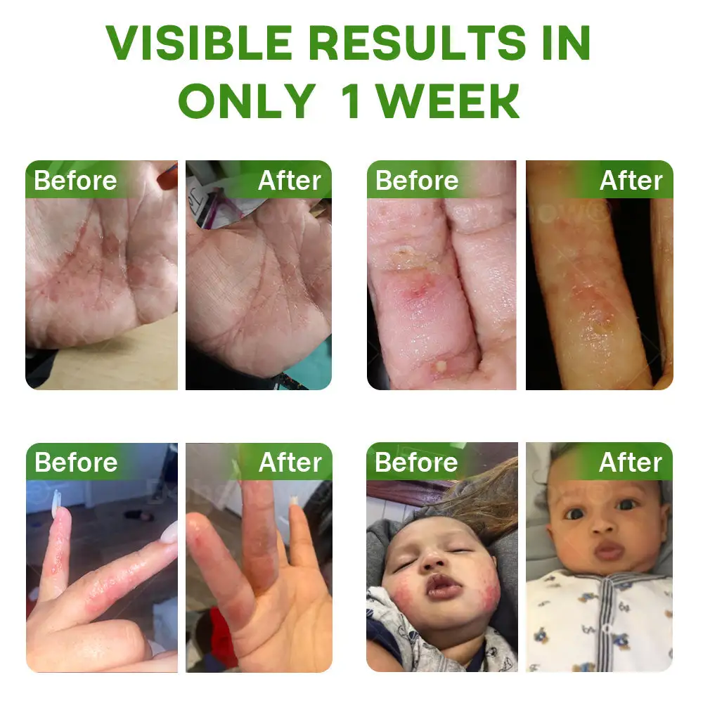 Herbal Psoriasis Relief Cream - Image 4