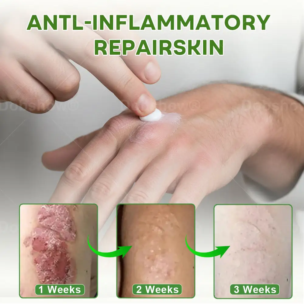 Herbal Psoriasis Relief Cream - Image 8