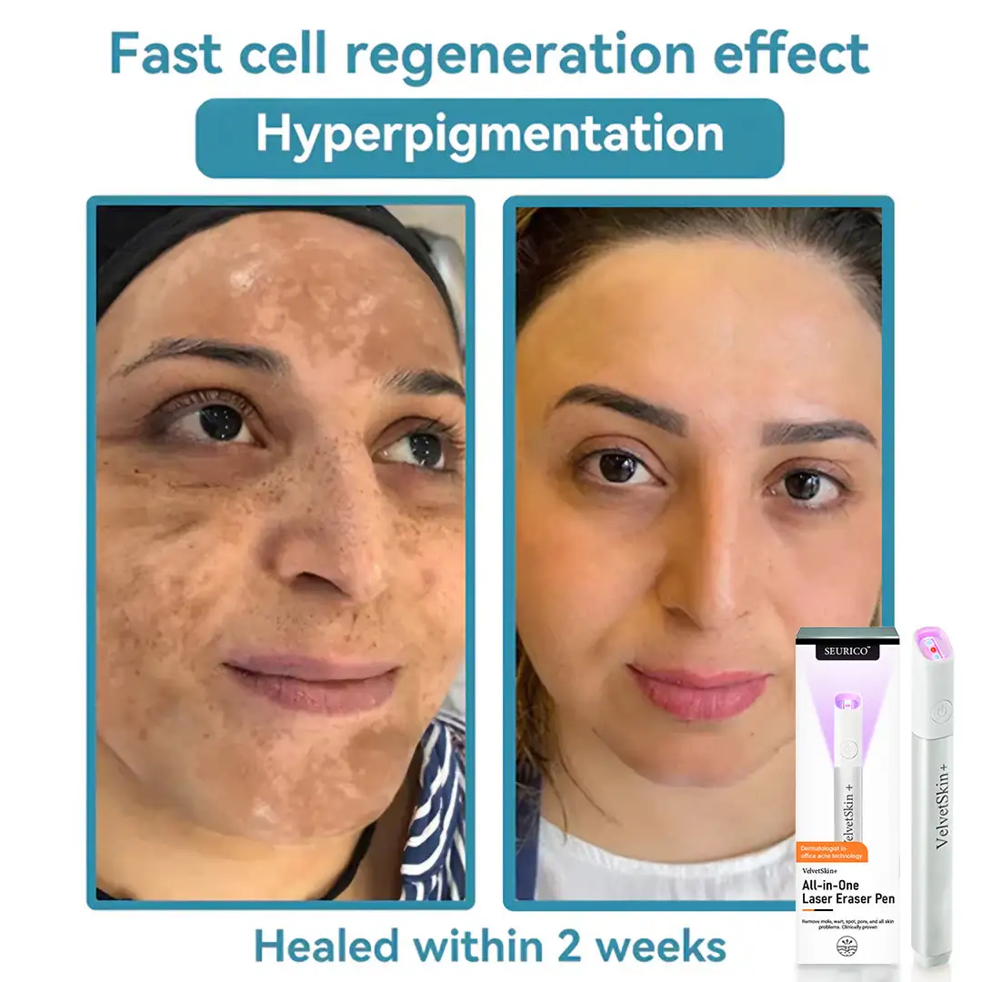 VelvetSkin+ All-in-One Laser Eraser Pen - Image 11