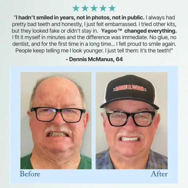 🦷Advanced Customized Full Denture Set🦷 (🔥10,000+ Sold In Last 30 Day) - Image 3