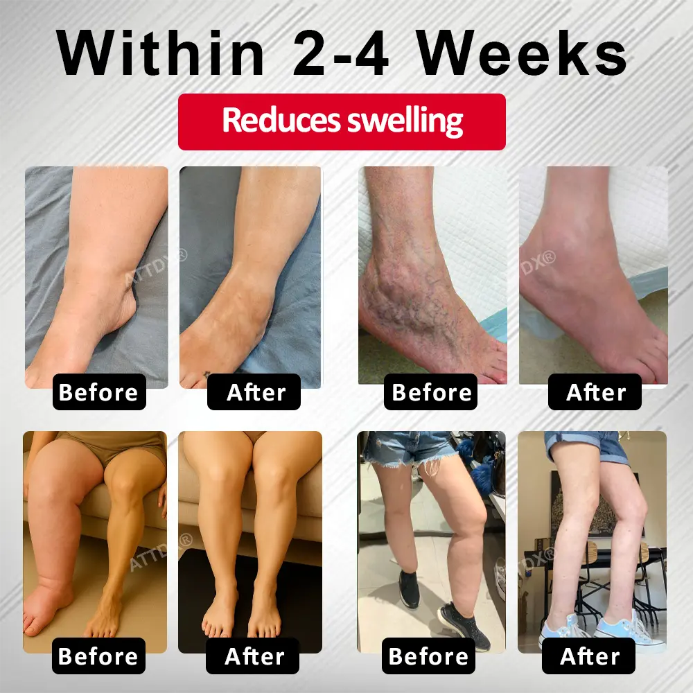 Advanced CVI Edema Therapy Cream - Image 3