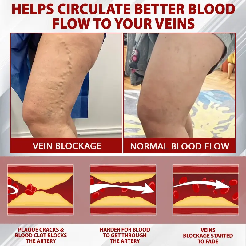 Advanced CVI Edema Therapy Cream - Image 7