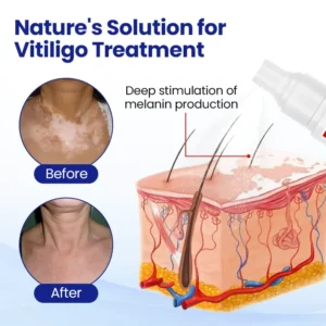 Alternative view of Vitiligo Spray: Psoralen-Powered Relief for White Spots & Irritation