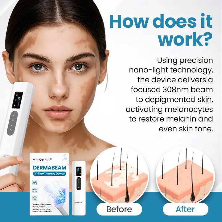 DermaBeam Vitiligo Therapy Device - Image 3