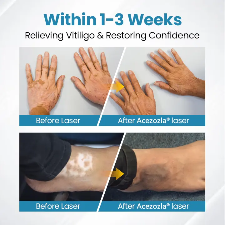 DermaBeam Vitiligo Therapy Device - Image 4