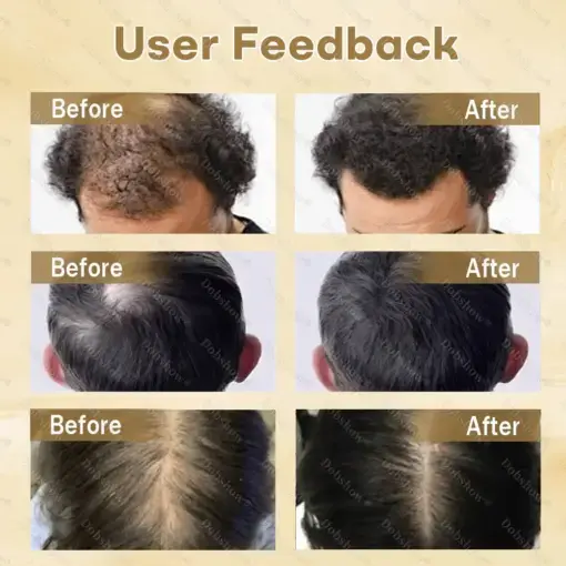Hair Regrowth Capsules Newly Upgraded,Nano Penetration, Deep into Hair Roots - Image 2
