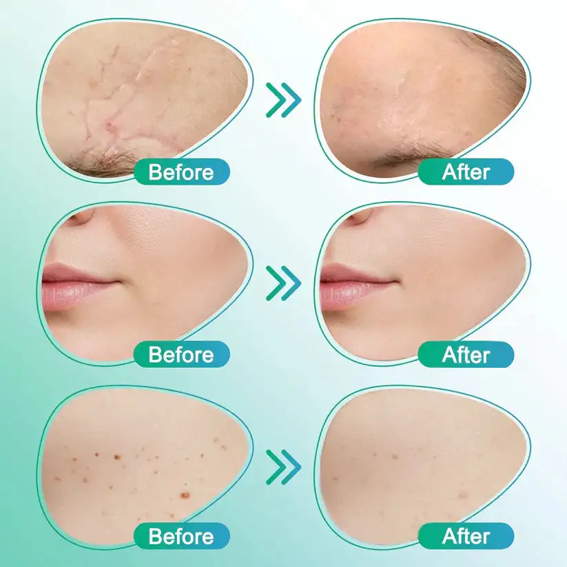 3-in-1 Microneedle Care Patch - Image 7