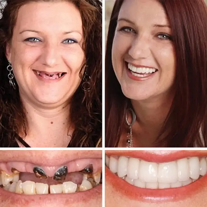 Medical Full Denture with Strong Suctiond Custom-Fit Full Functional Dentures - Image 10