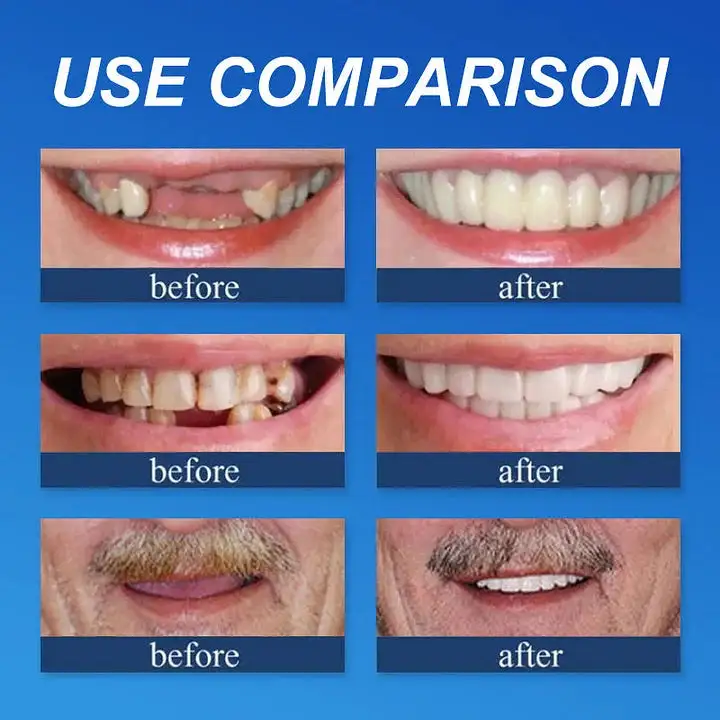 Medical Full Denture with Strong Suctiond Custom-Fit Full Functional Dentures - Image 7