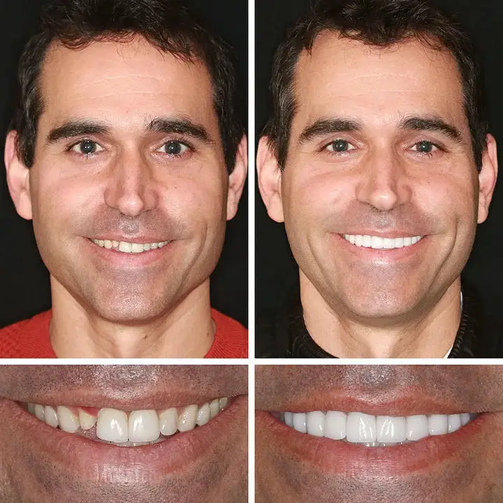 Medical Full Denture with Strong Suctiond Custom-Fit Full Functional Dentures - Image 9