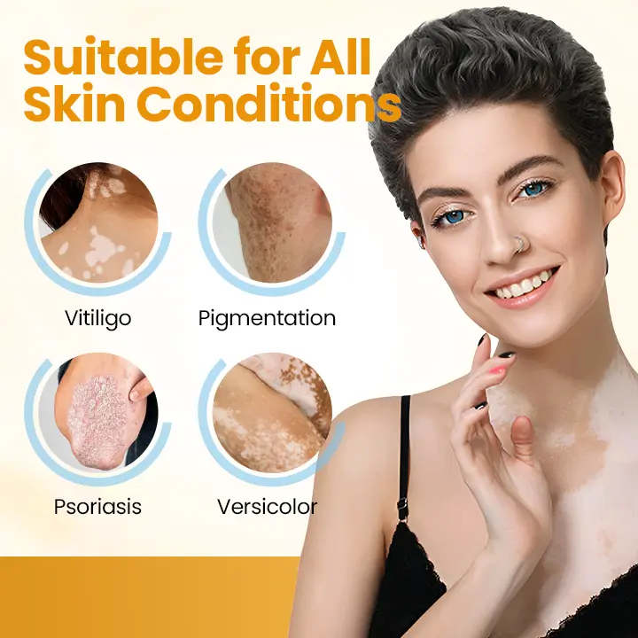 VitiGone Rapid Spray — 2–3 Week Repigmentation with OTDS - Image 10