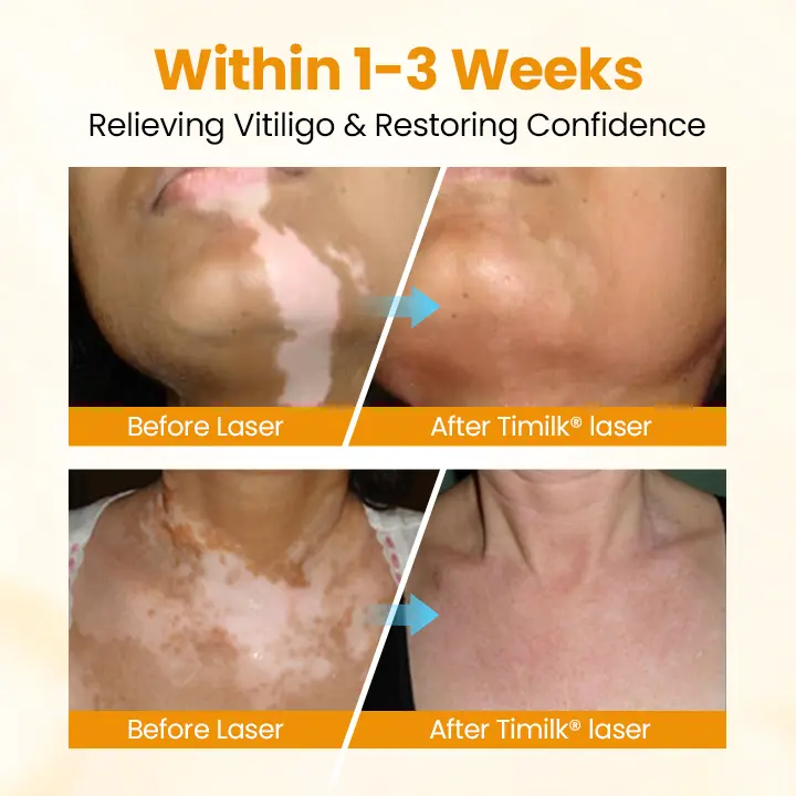 VitiGone Rapid Spray — 2–3 Week Repigmentation with OTDS - Image 6
