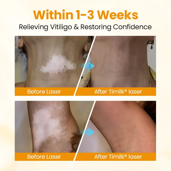 VitiGone Rapid Spray — 2–3 Week Repigmentation with OTDS - Image 7