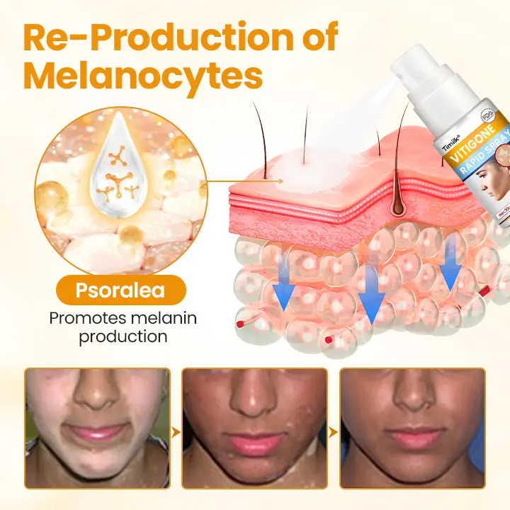 VitiGone Rapid Spray — 2–3 Week Repigmentation with OTDS - Image 8